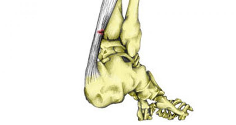 Ta Rupture Achilles Tendon Rupture - Symptoms, Causes & Treatment