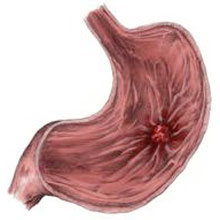 Peptic ulcers often develop due to bacteria infection