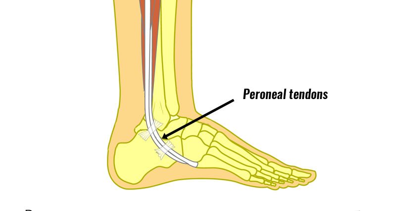 Peroneal tendon dislocation