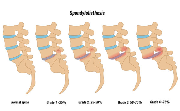 Spondylolisthesis grades