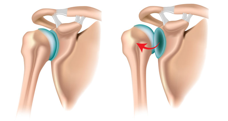 Posterior shoulder dislocation