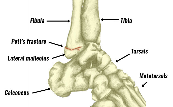 Potts fracture