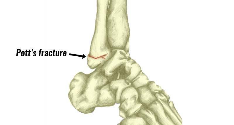 Pott's fracture broken ankle