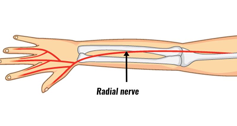 Radial tunnel syndrome
