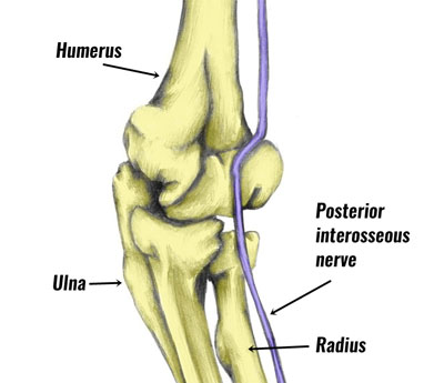 Radial tunnel syndrome