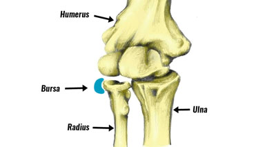 Radiohumeral bursitis