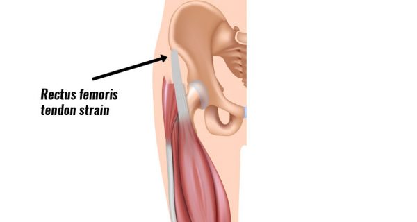 Rectus femoris tendon strain