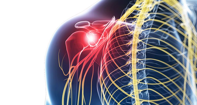 Referred shoulder pain