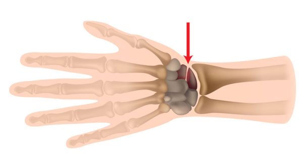 Scaphoid fracture