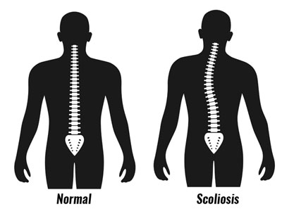 Scoliosis
