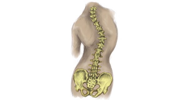 Scoliiosis