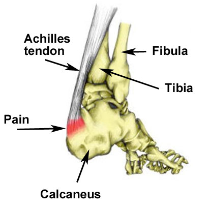 Sever's Disease image