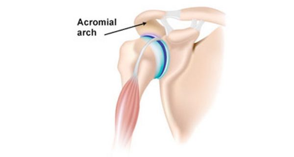 Shoulder impingement