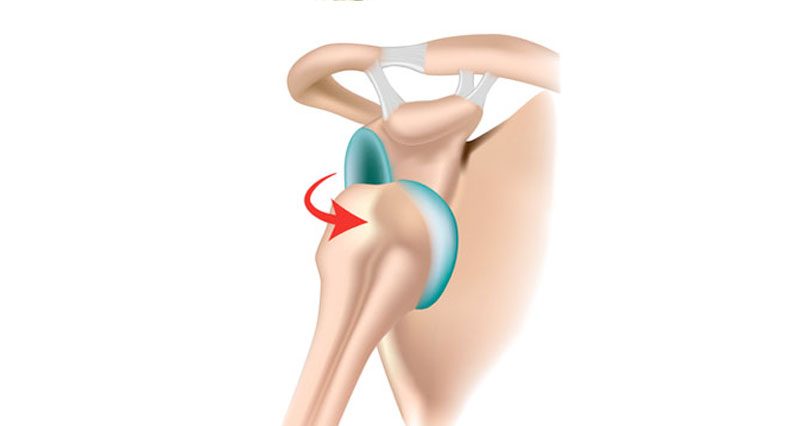 Shoulder subluxation