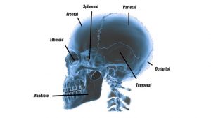 Skull fracture