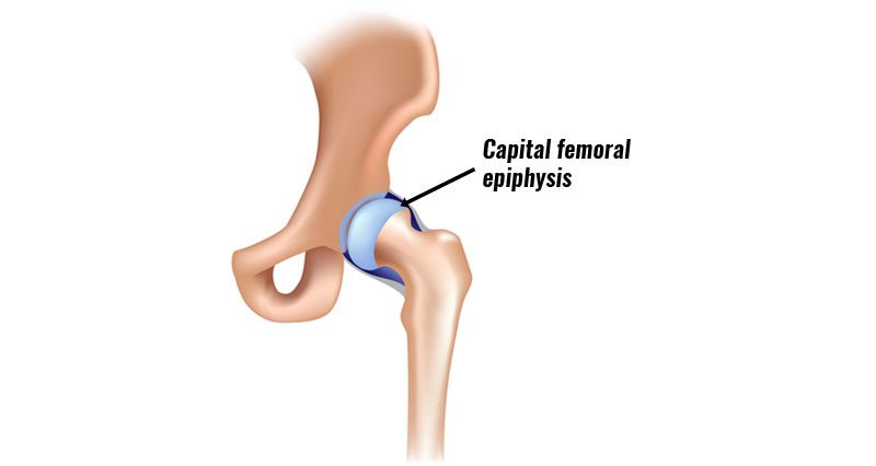 Slipped Femoral Capital Epiphysis