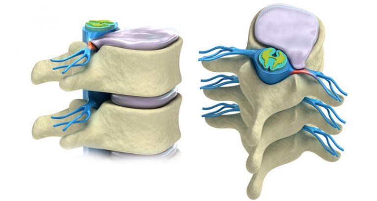 Slipped disc - Prolapsed Disc - Symptoms, Causes & Treatment