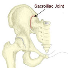 Spondylitis