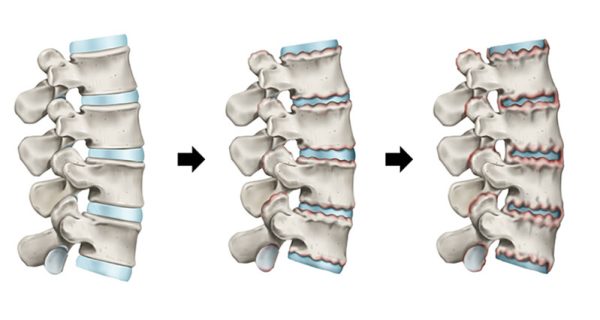 spondylitis