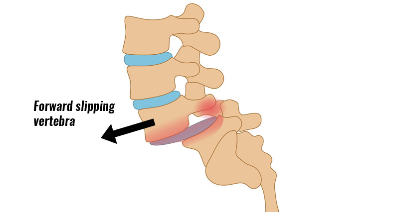 spondylolisthesis was ist das