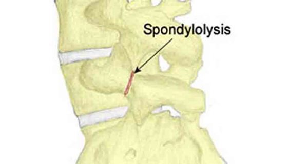 Spondylolysis
