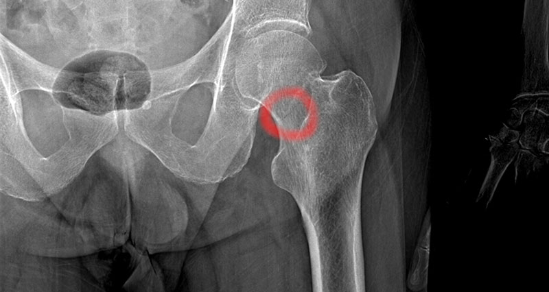 Femur stress fracture