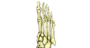 Stress Fractures
