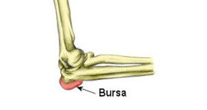 Elbow Bursitis