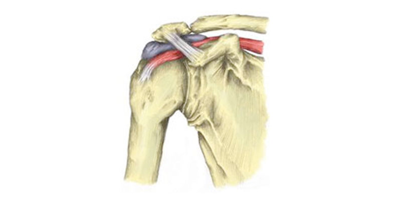 Subacromial bursitis