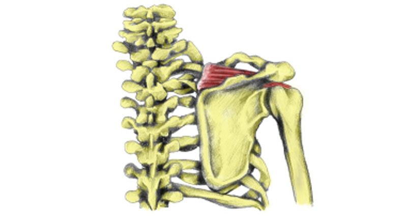 Supraspinatus tear