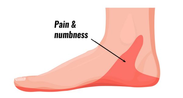 Tarsal tunnel syndrome pain location