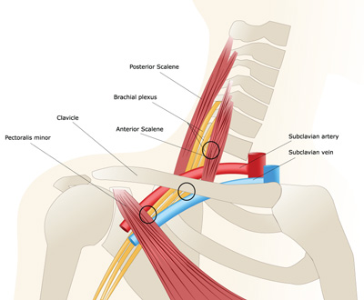 Thoracic outlet syndrome