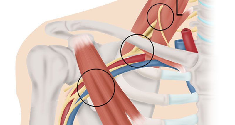Thoracic Outlet Syndrome - Symptoms, Causes, Treatment and Exercises