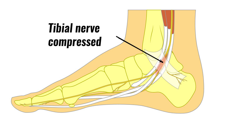 Tarsal tunnel nerce compression