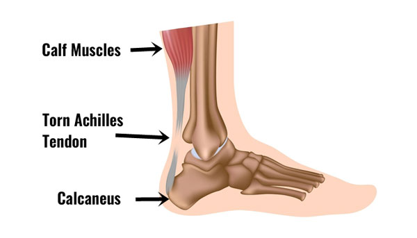 Total rupture of the achilles tendon