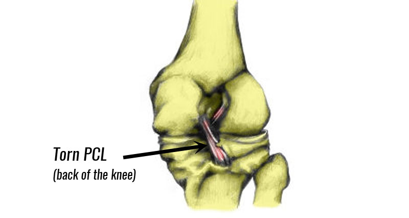 Torn PCL