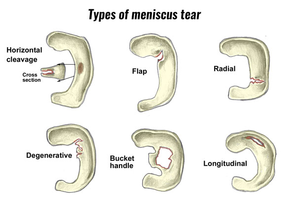Types of knee cartilage meniscus tear