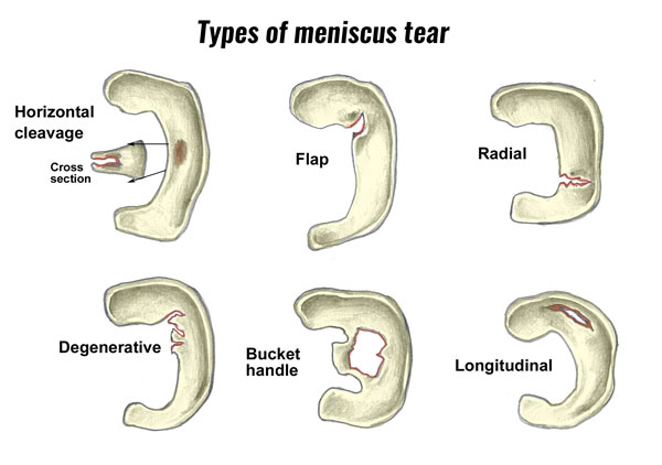 Tipos de lesão meniscal da cartilagem do joelho