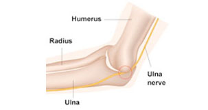 Ulnar Nerve Contusion