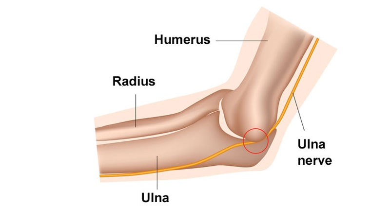 Ulna nerve - Cubital tunnel syndrome