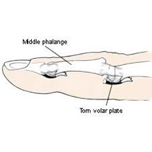 Volar Plate Injury
