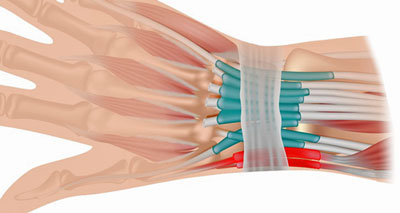 Wrist tendonitis