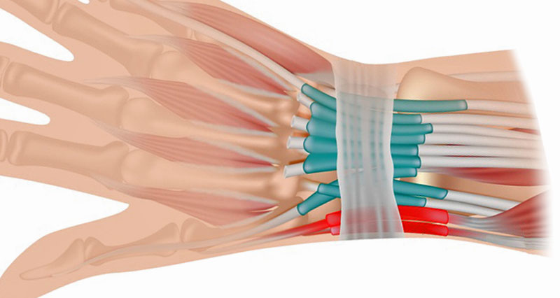 Wrist tendonitis