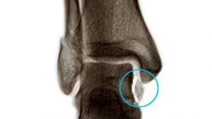Ankle avulsion fracture