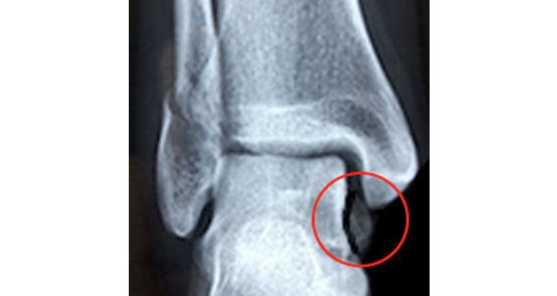 Ankle Avulsion Fracture - Symptoms, Causes & Treatment