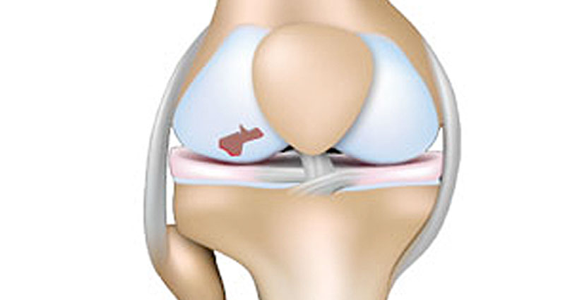 Articular knee cartilage
