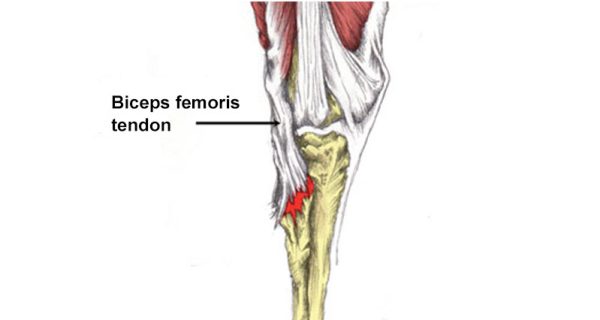 Biceps femoris avulsion