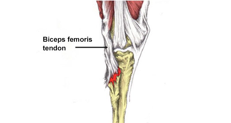 Biceps femoris avulsion