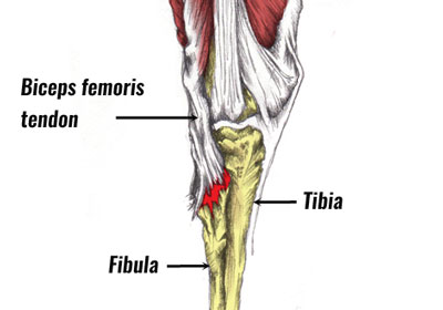 fracture avulsion du biceps fémoral