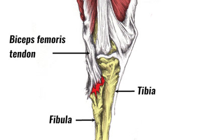 Hamstring tendon strain